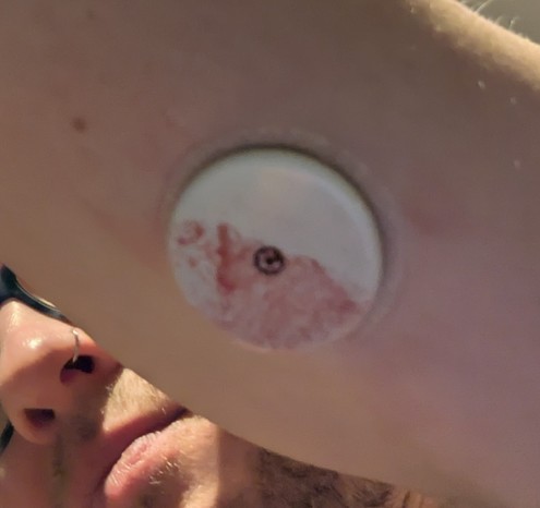 A blood-spattered Continuous Glucose Sensor attached to my arm